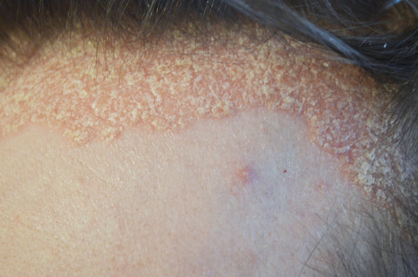 Psoriasis 101