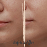 KIWI™ derma