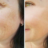 Hyaluronic Acid