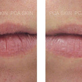 Hyaluronic Acid