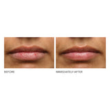 Hyaluronic Acid